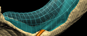 mandible reconstruction project